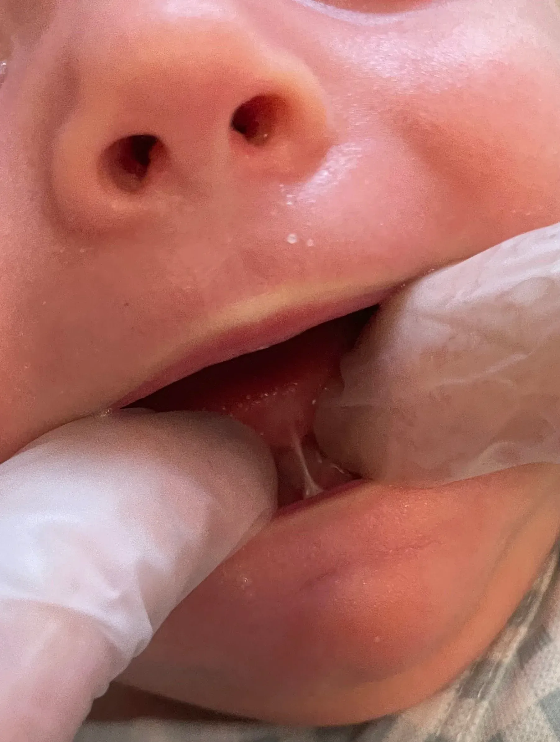 Nærbilde av en munn med en tynn vevsmembran som forbinder tungen med munnbunnen, holdt åpen av hansker på hendene.