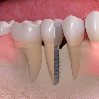 visione 3D impianto dentale