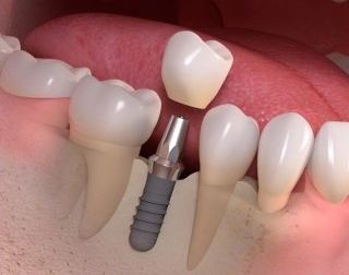 installazione protesi dentale