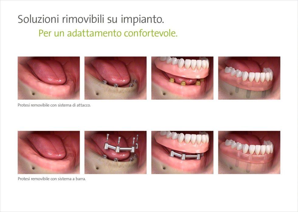 fasi di installazione impianto dentale