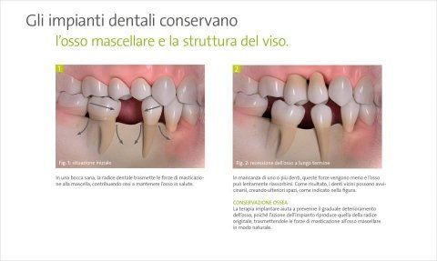 impianti dentali