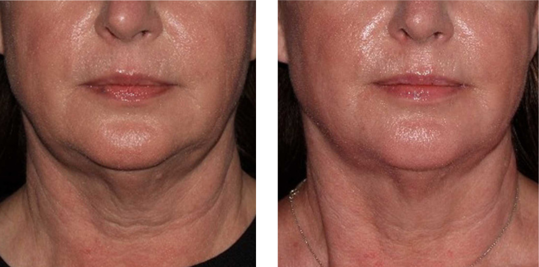 A before and after photo of a woman 's neck and face.