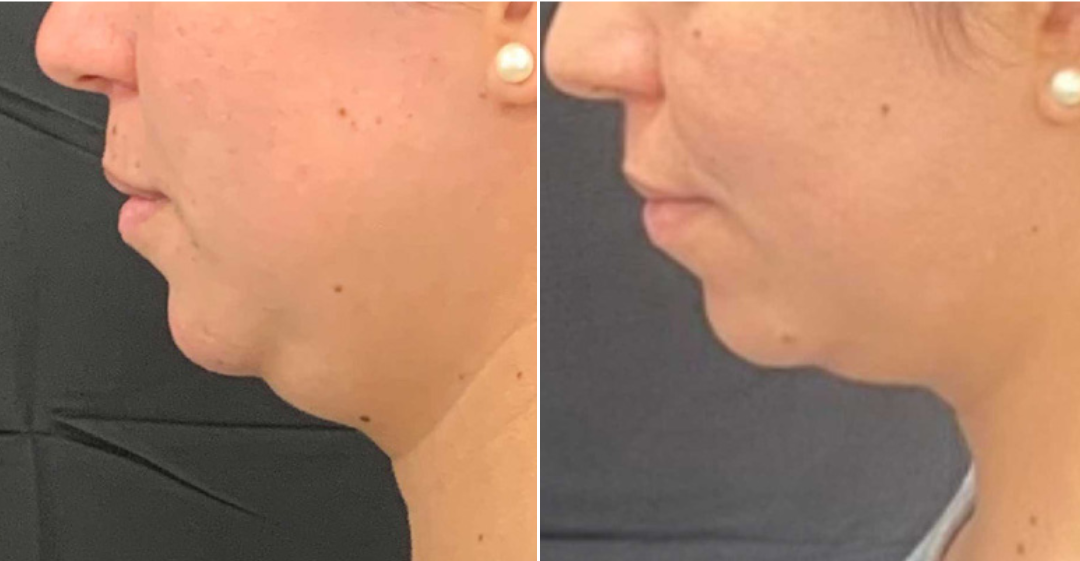 A before and after photo of a woman 's neck and chin.