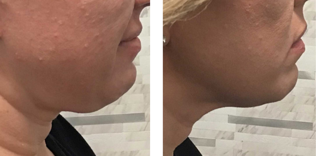 A before and after photo of a woman 's neck and chin.