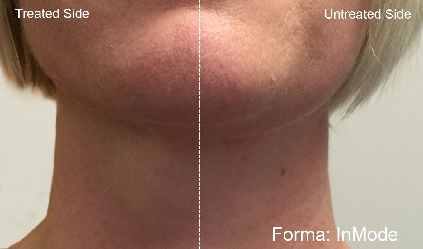 A woman 's face is shown before and after Forma treatment.