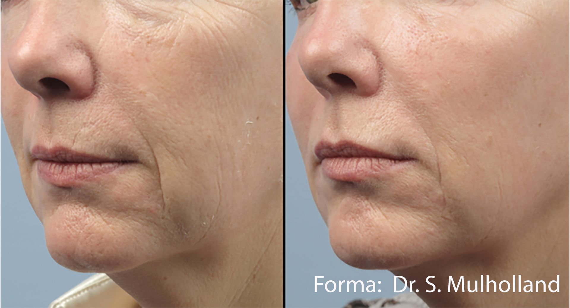 A before and after photo of a woman 's face after Forma treatment.