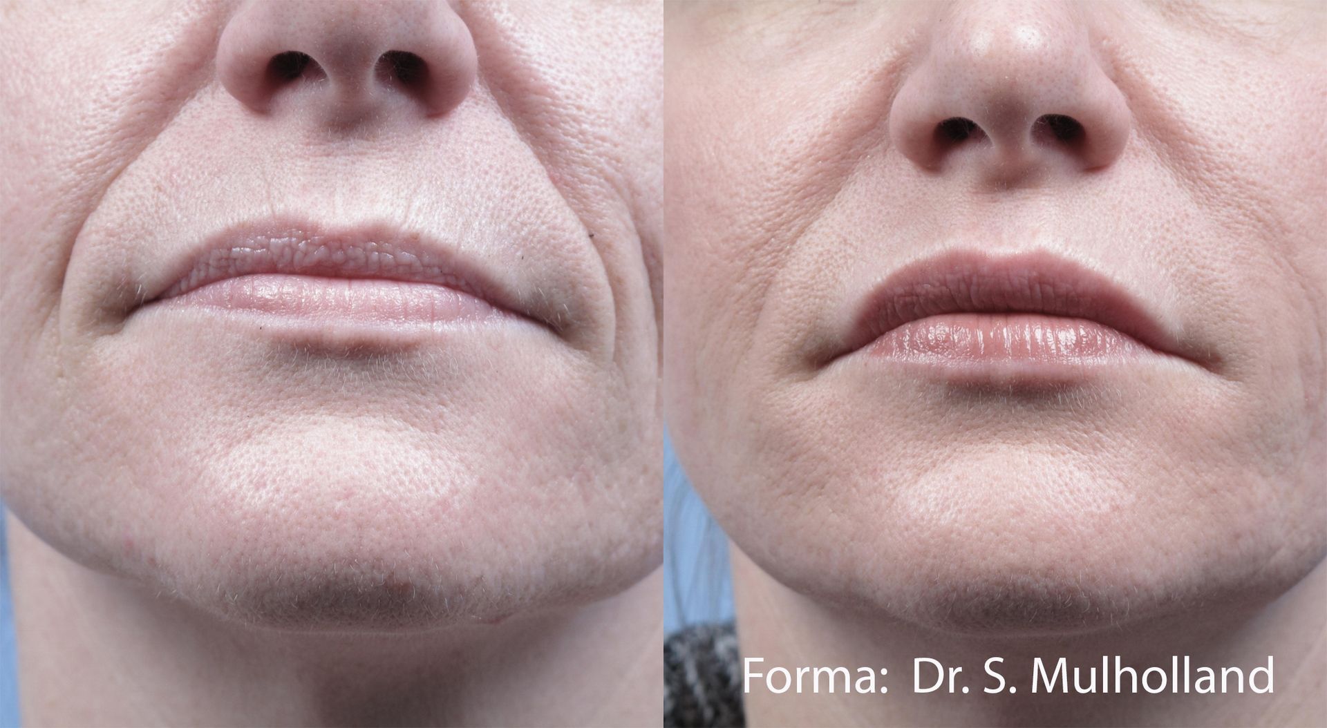 A before and after photo of a woman 's face after Forma treatment.