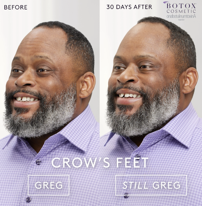 A man with a beard before and after botox