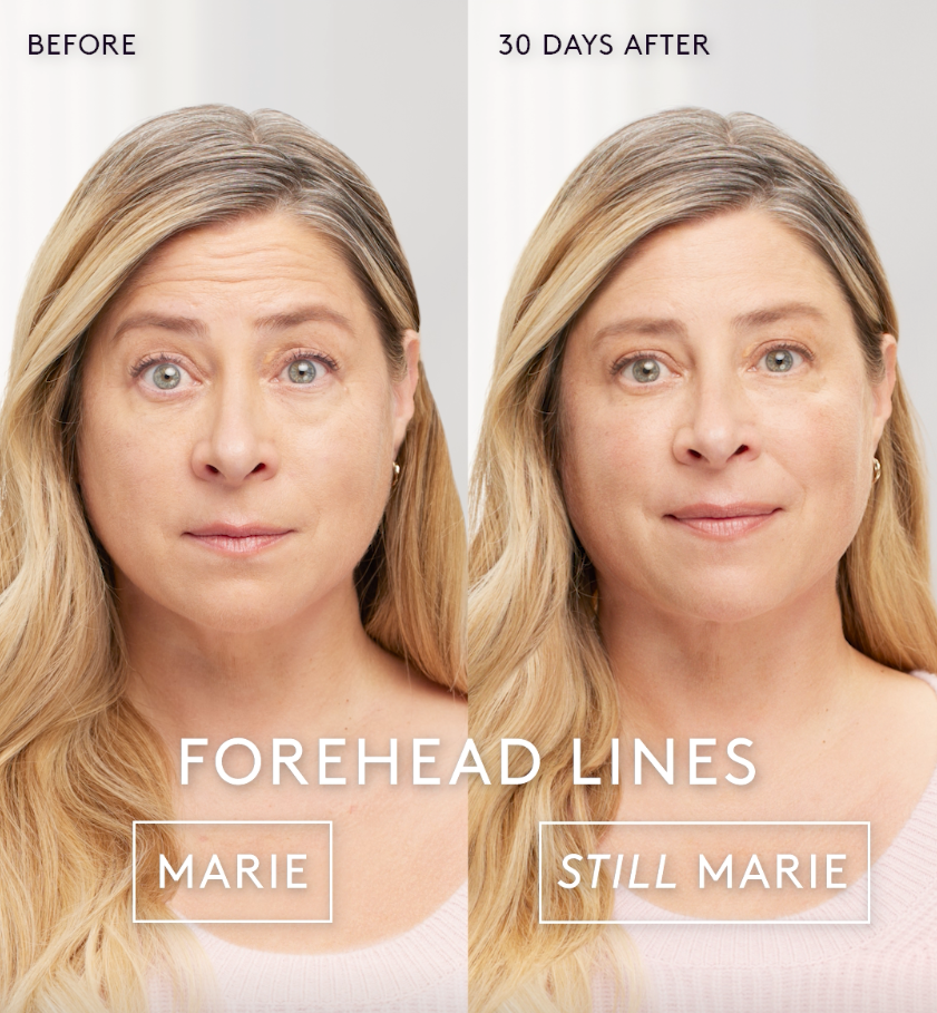 A before and after photo of a woman 's forehead lines