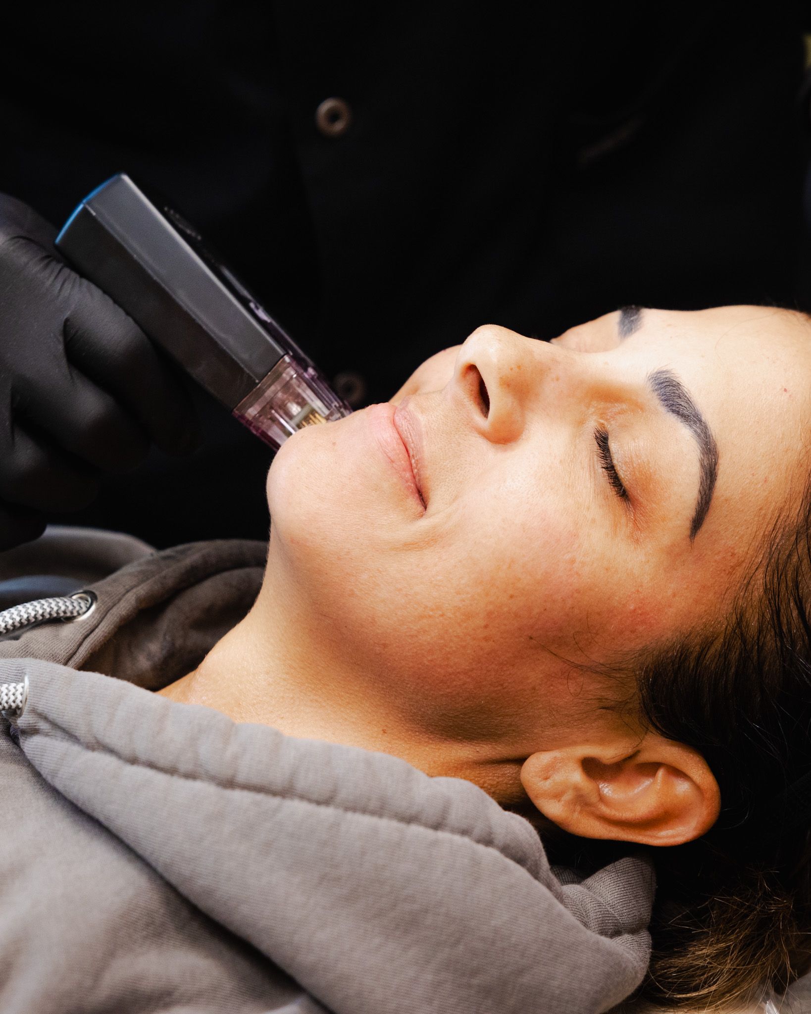 A woman is getting a treatment on her face with Morpheus8.