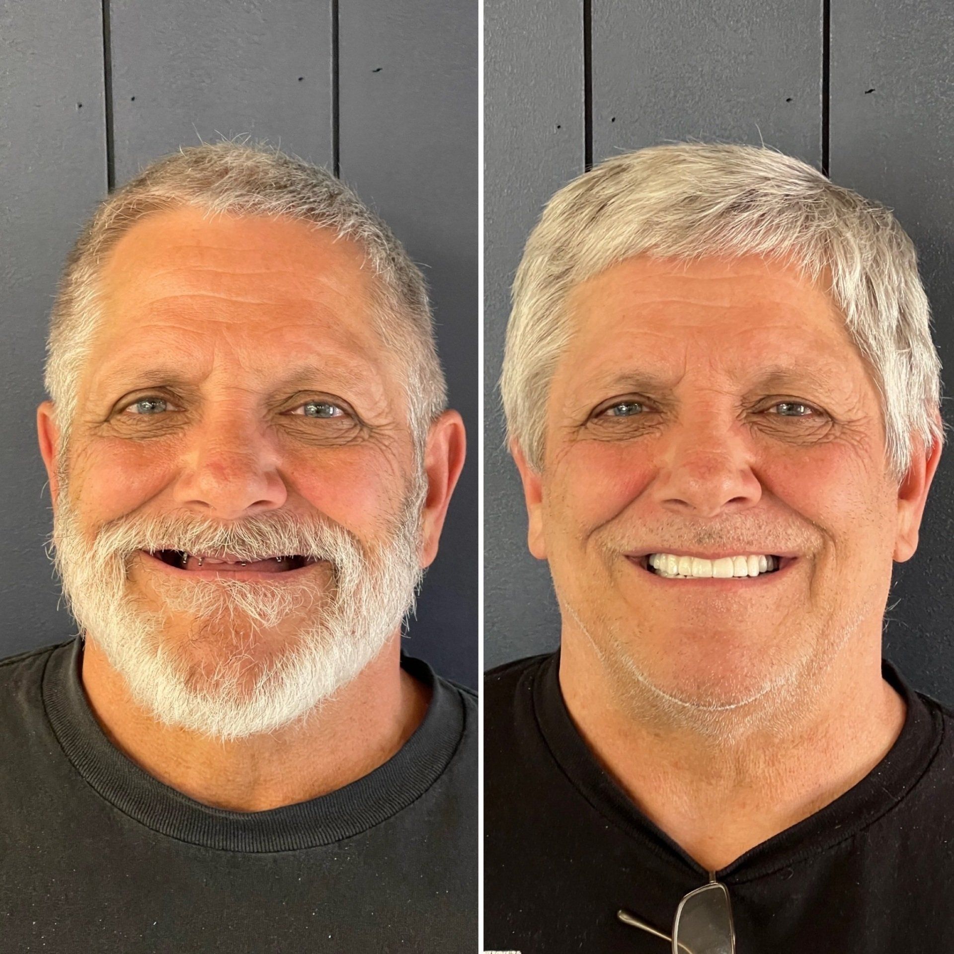 Dental Implants North End Dental