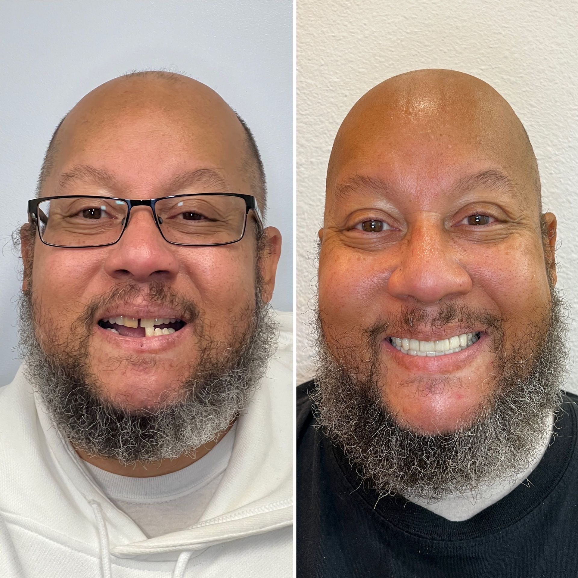 Dental Implants North End Dental