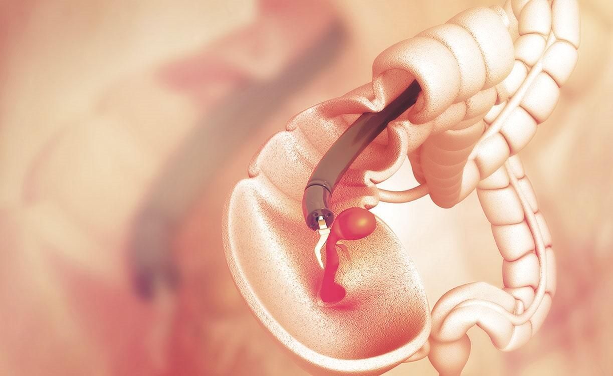 Un primer plano del estómago de una persona con una aguja saliendo de él.