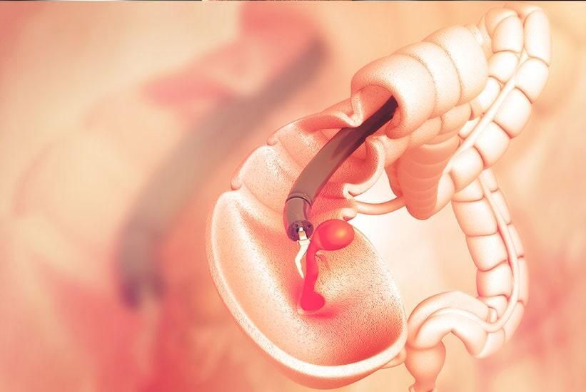 Un primer plano del estómago de una persona con una aguja saliendo de él.