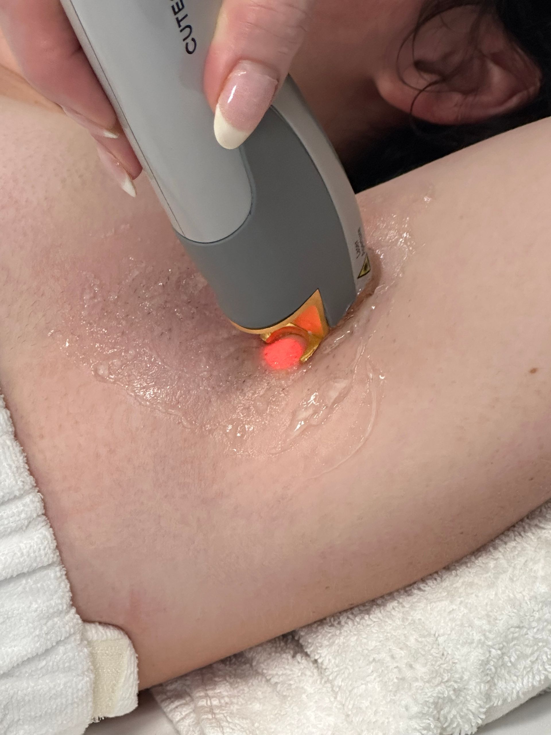 laser hair removal treatment