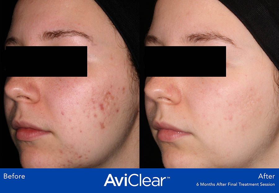before and after aviclear treatment