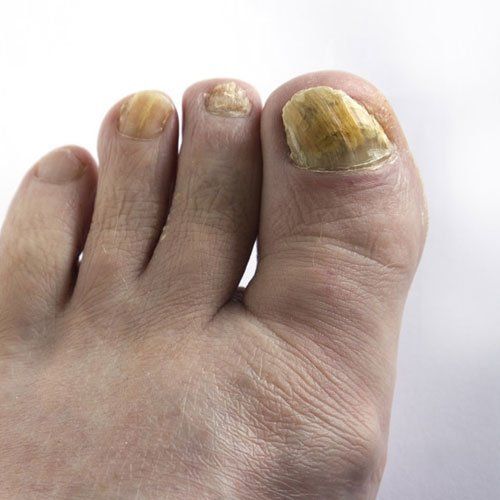 thick toenails