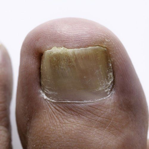 Ingrown toenail