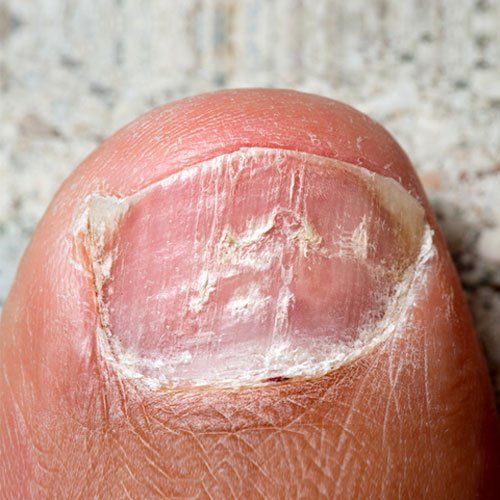 Fungal nail