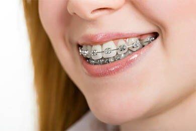 Woman with Braces — Orthodontics in Haverhill, MA