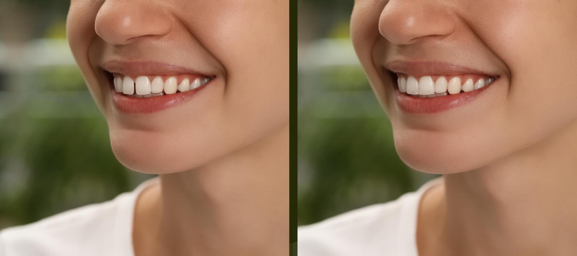 Vergleichsbild: Zähne links ohne und rechts mit Veneers. 