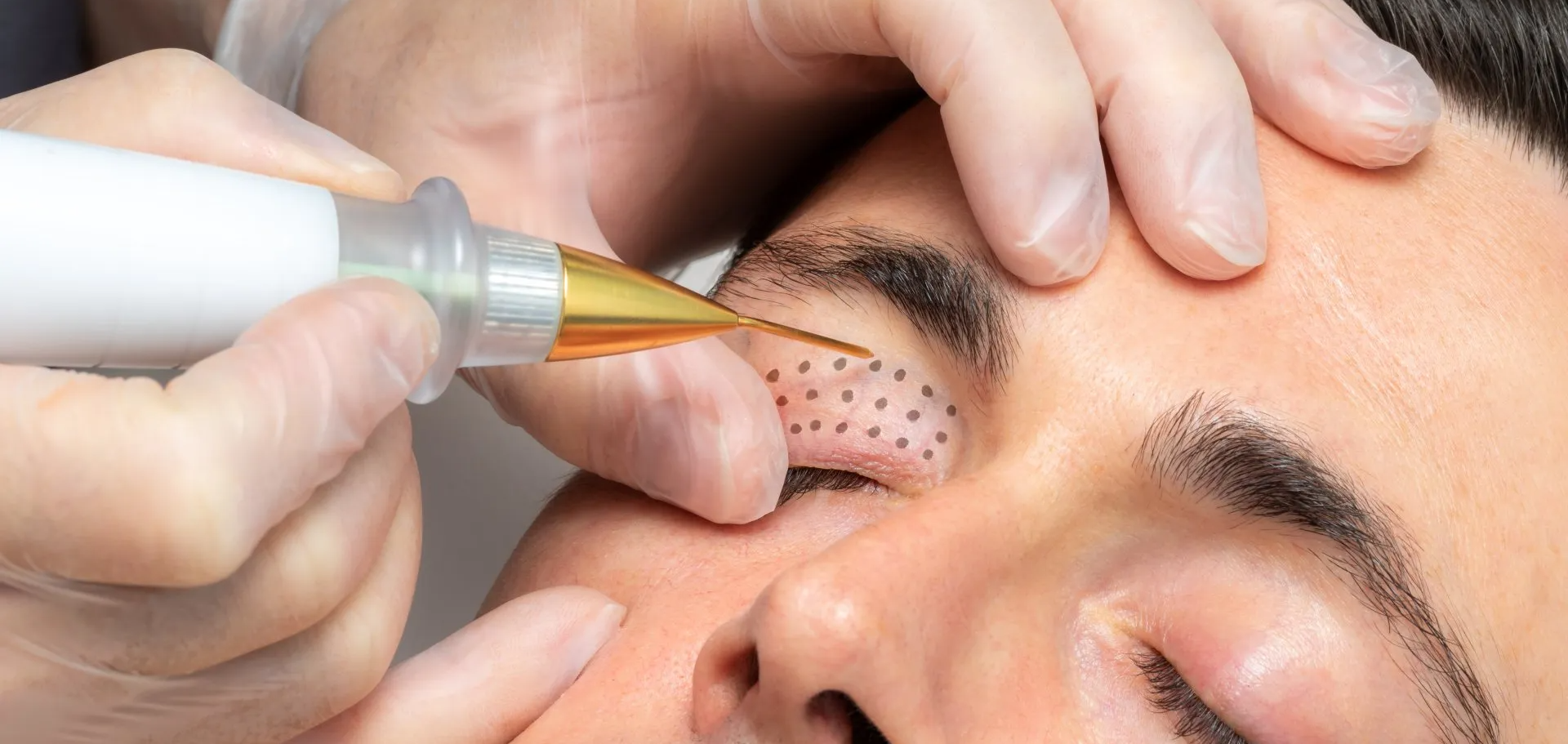 A man is getting a laser treatment on his eyebrows.