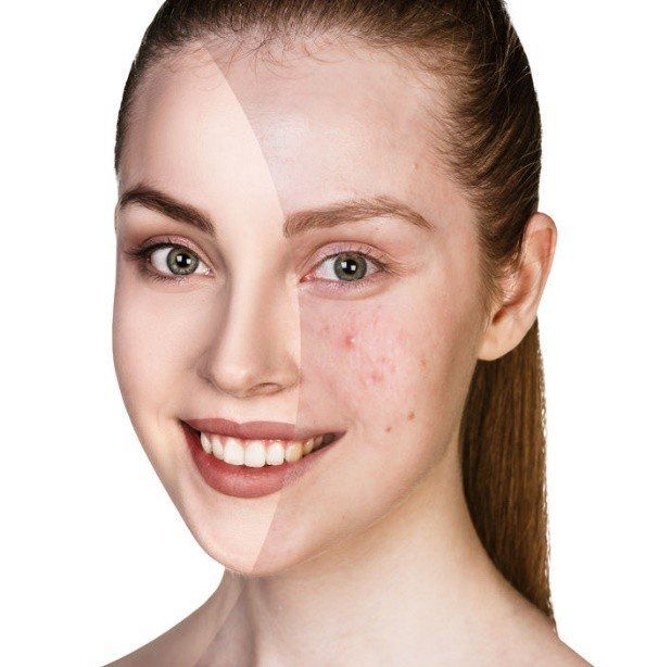 A woman 's face is shown before and after acne treatment.