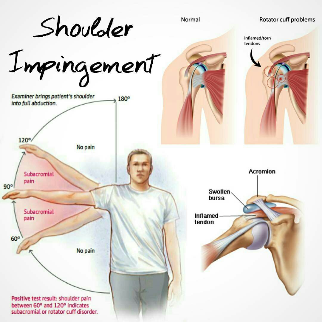 shoulder pain when raising arm