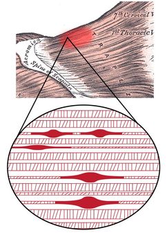 trigger point therapy