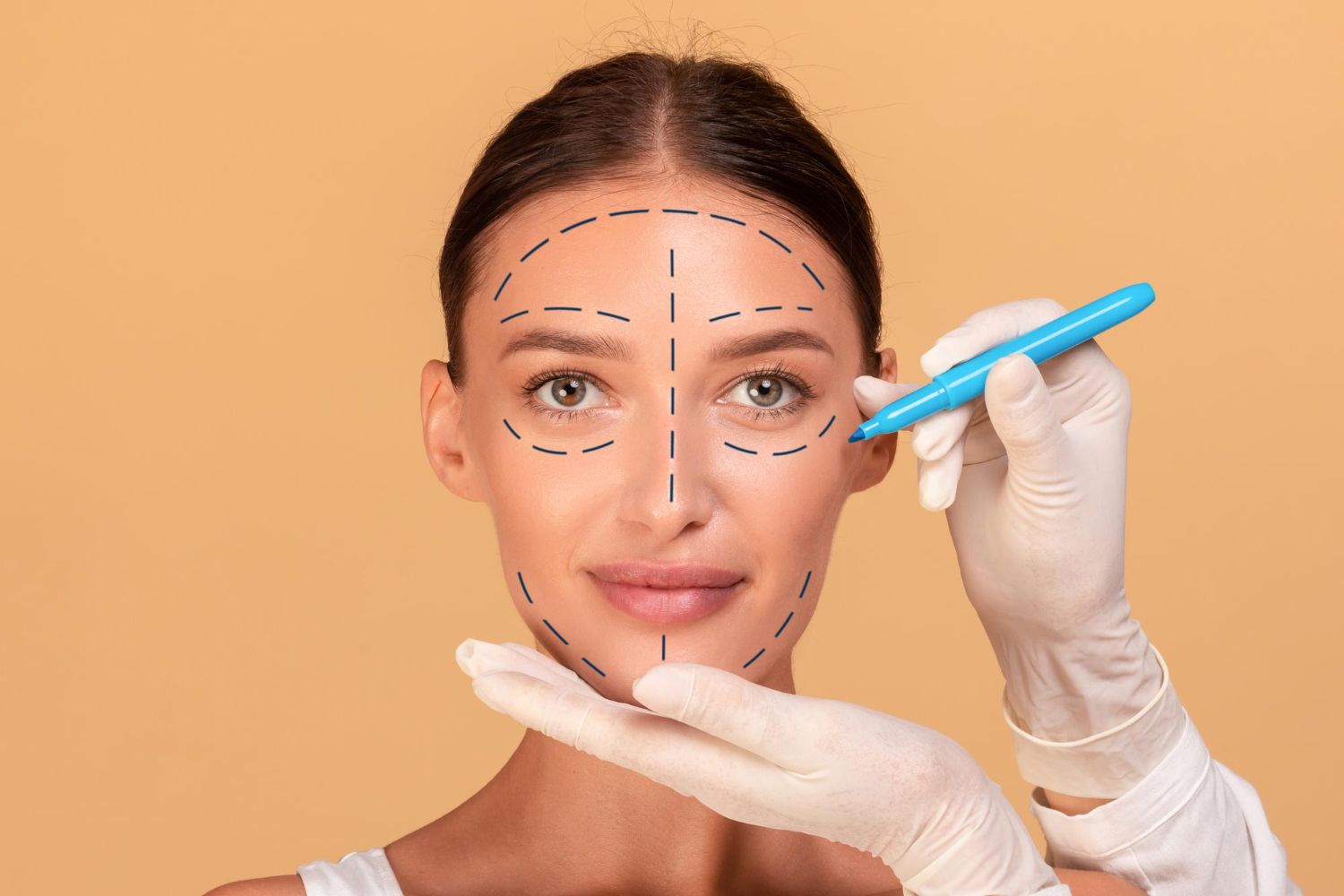 Woman's face marked for cosmetic surgery; doctor's gloved hand holding pen, drawing lines.