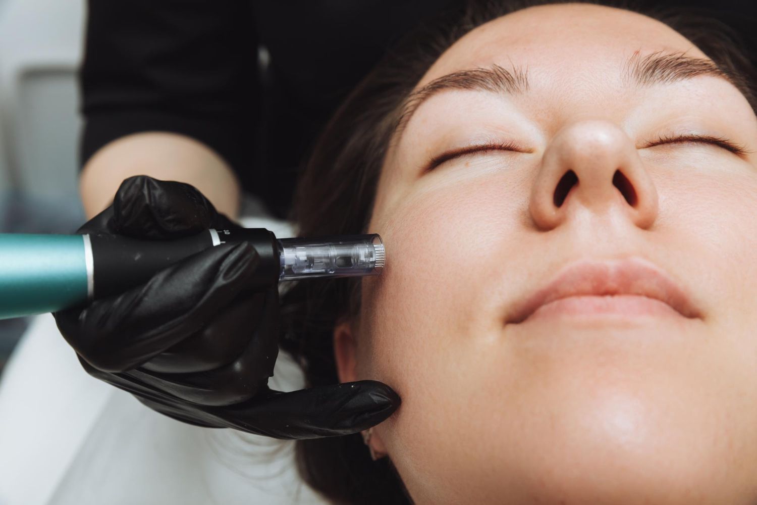 Woman receiving micro-needling facial treatment. A gloved hand holds the device near her cheek.