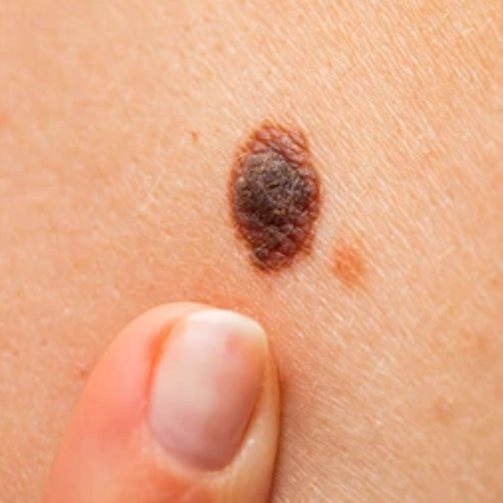 A close up of a woman 's neck with a mole