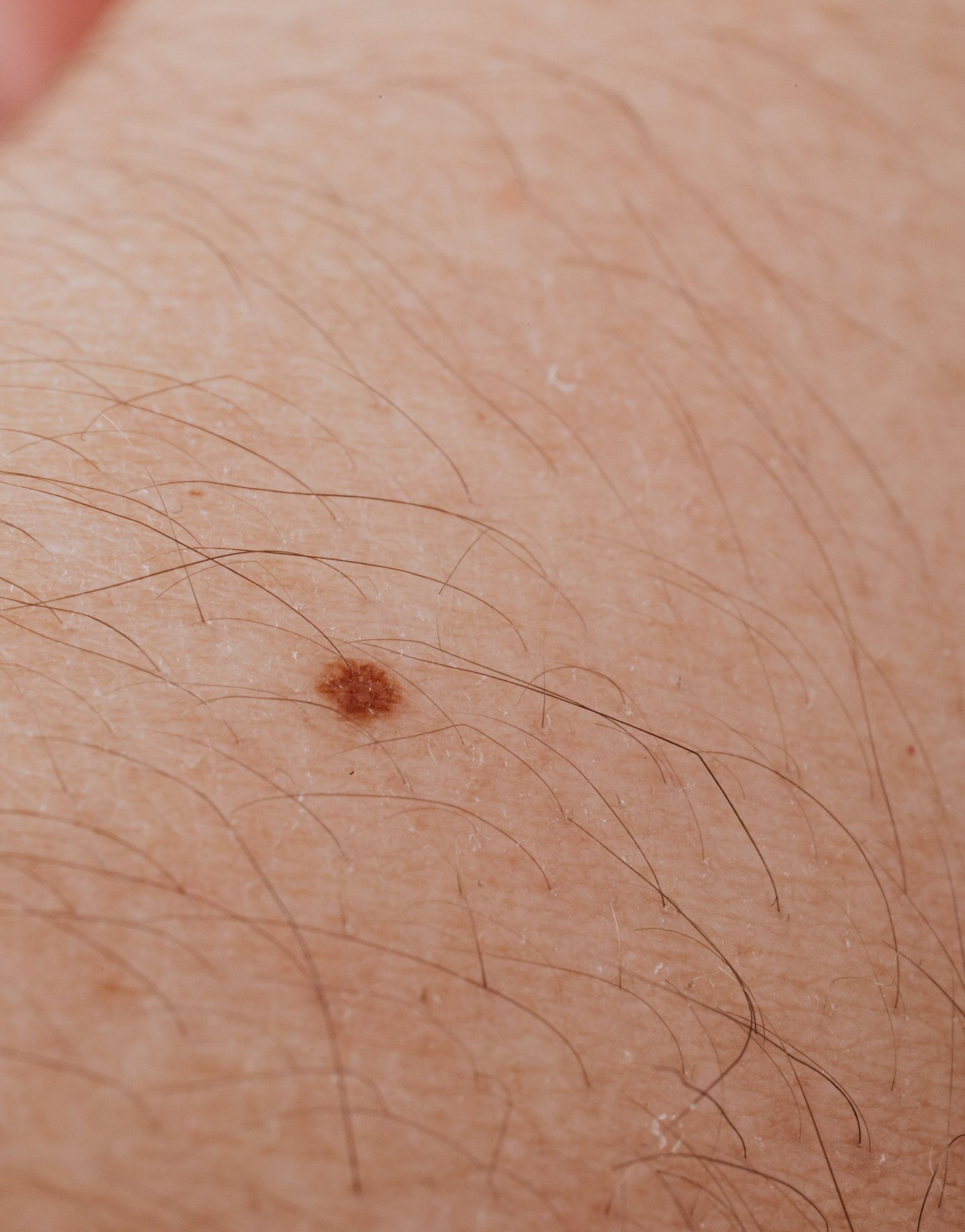 A close up of a person 's skin with a small brown spot on it.