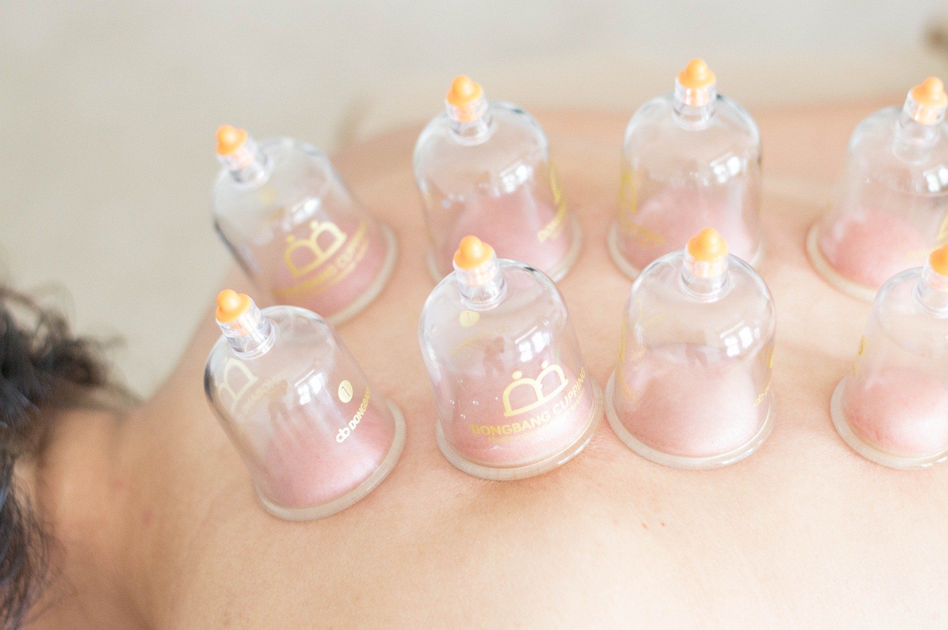 Cupping Therapy