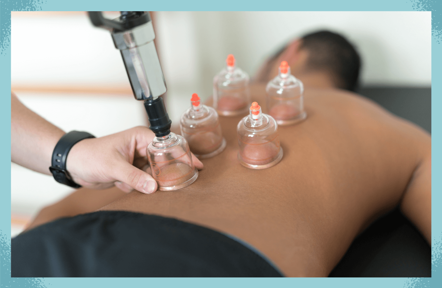 Cupping Therapy Demonstration