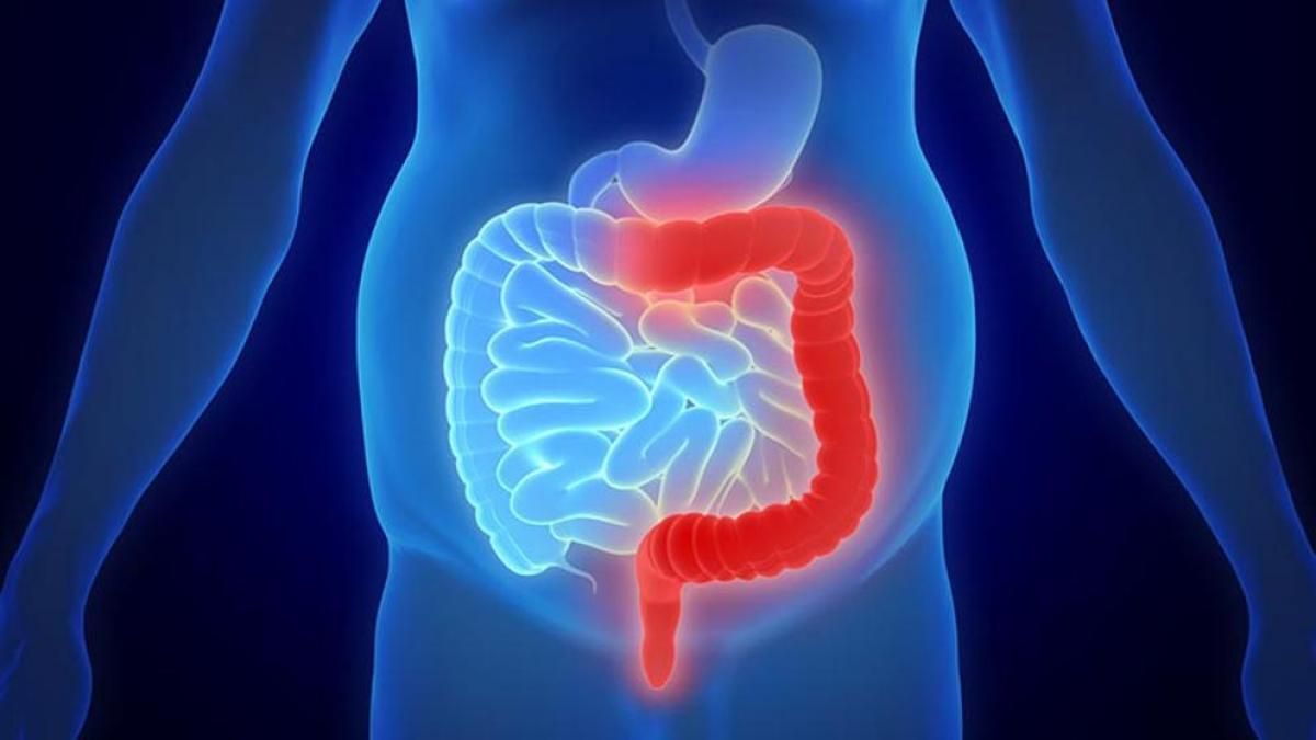 Rectal bleeding is a common symptom associated with ulcerative colitis.