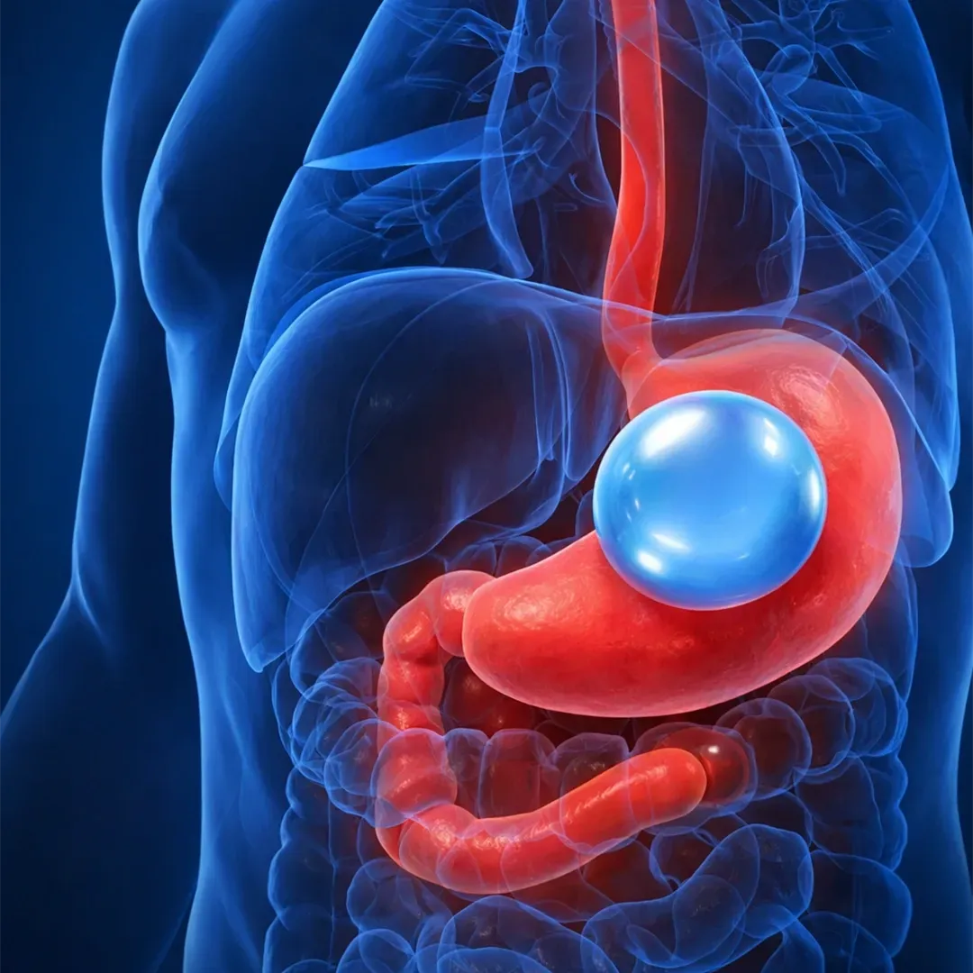 Gastric balloon procedures have emerged as a non-surgical option for individuals seeking