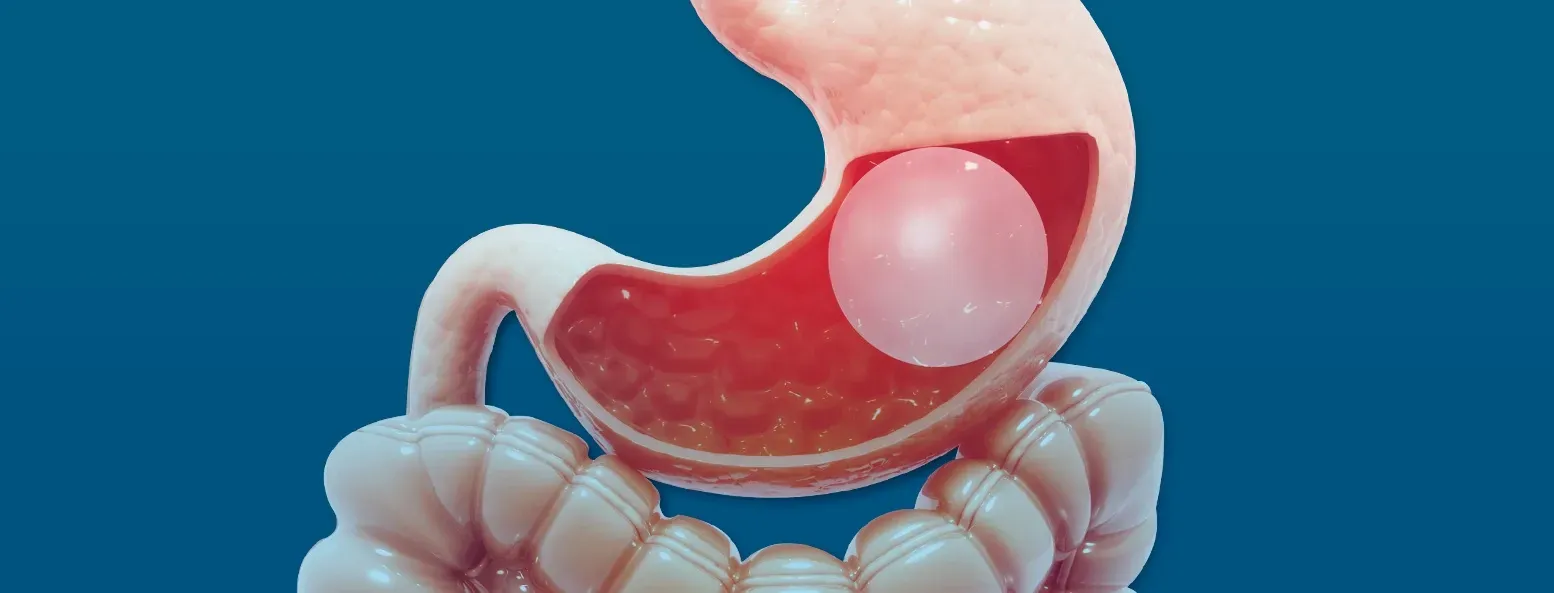 Weight loss can be a challenging journey, but innovative solutions like the Orbera gastric balloon