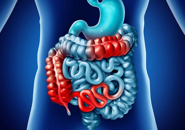 Inflammatory Bowel Disease (IBD) encompasses chronic conditions that cause inflammation