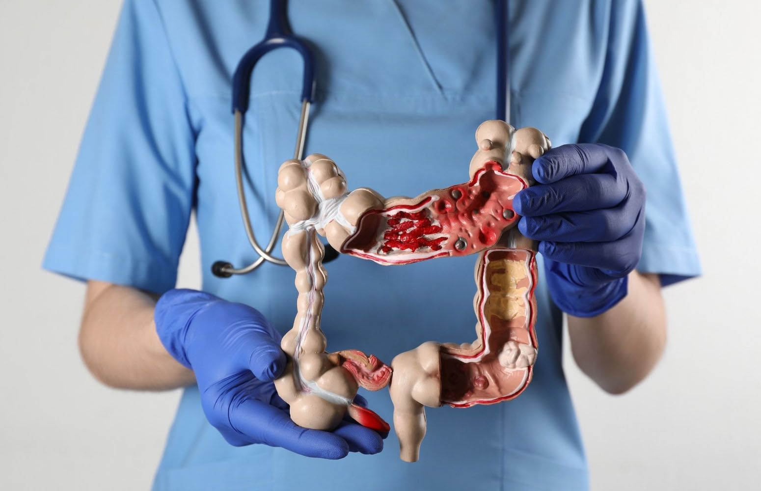 Screening colonoscopy is a vital tool in the prevention and early detection of colorectal cancer 