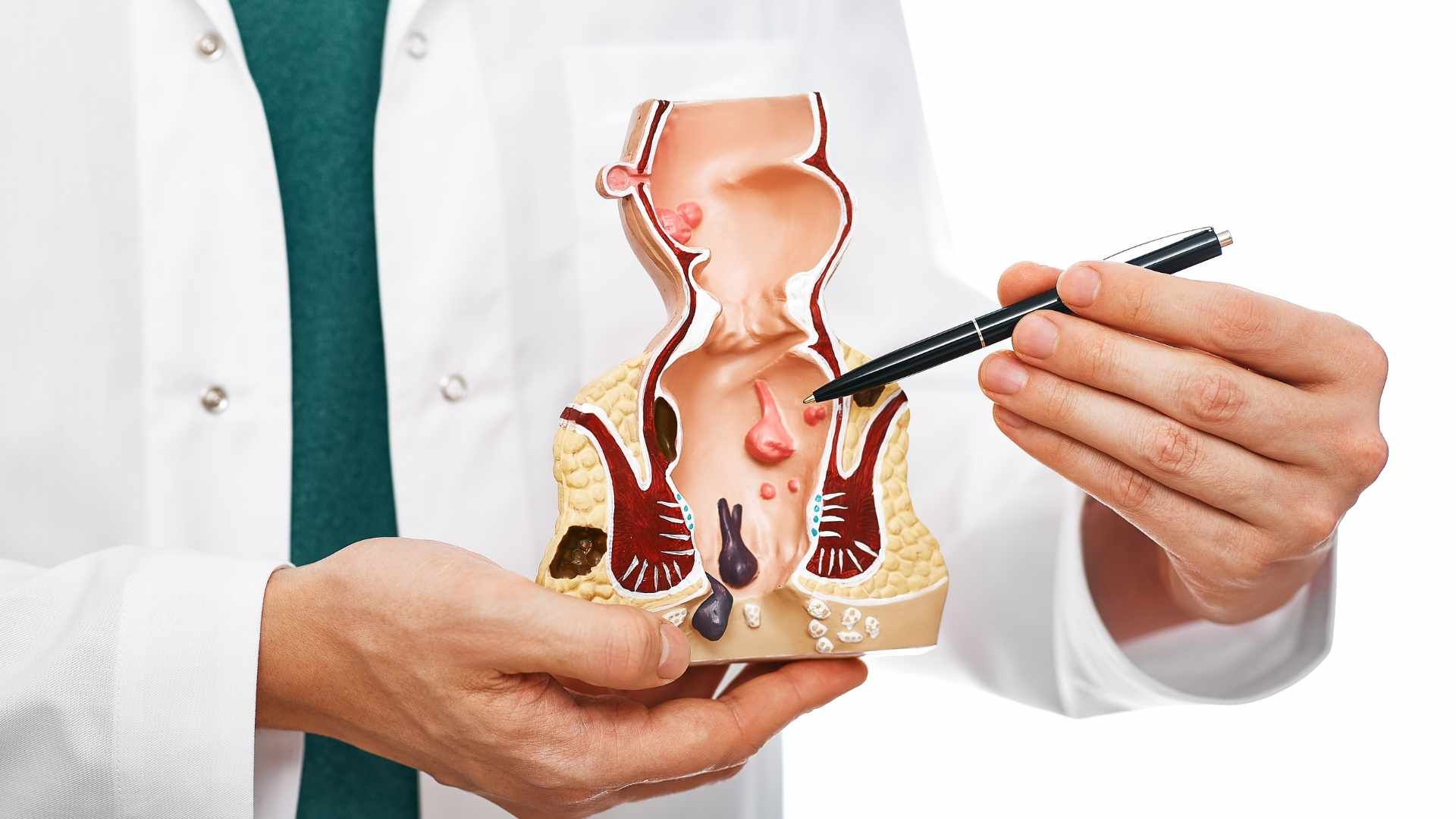 Hemorrhoids, a common digestive issue affecting many individuals