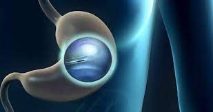 The gastric balloon is a non-surgical weight loss procedure that has gained popularity 