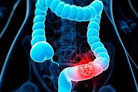 Colonoscopy is a vital procedure in the early detection and prevention of colon cancer