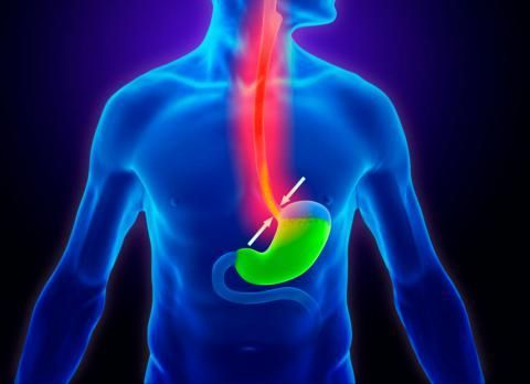 Gastroesophageal reflux disease (GERD) is a common digestive disorder
that affects 