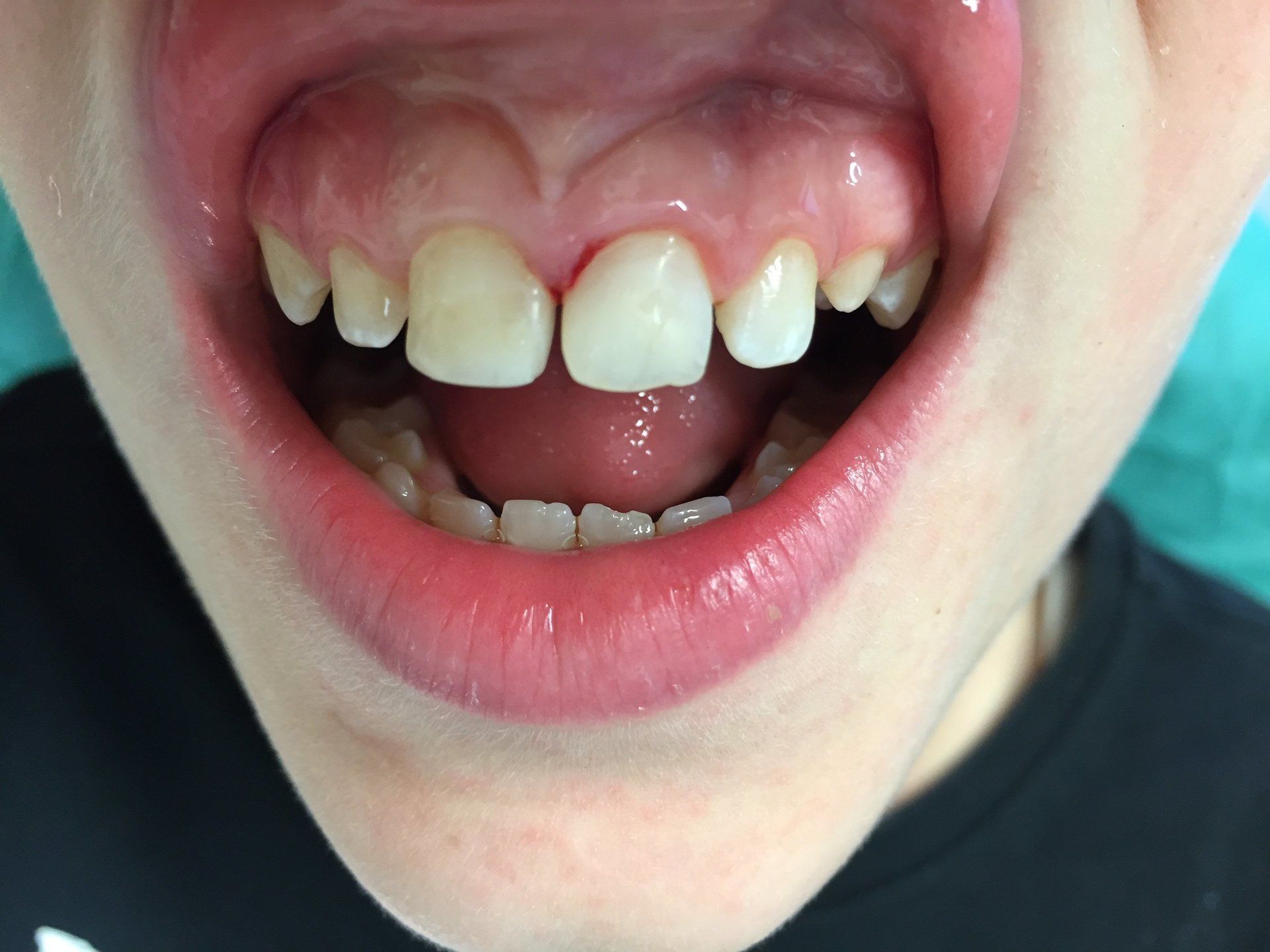 dopo la ricostruzione