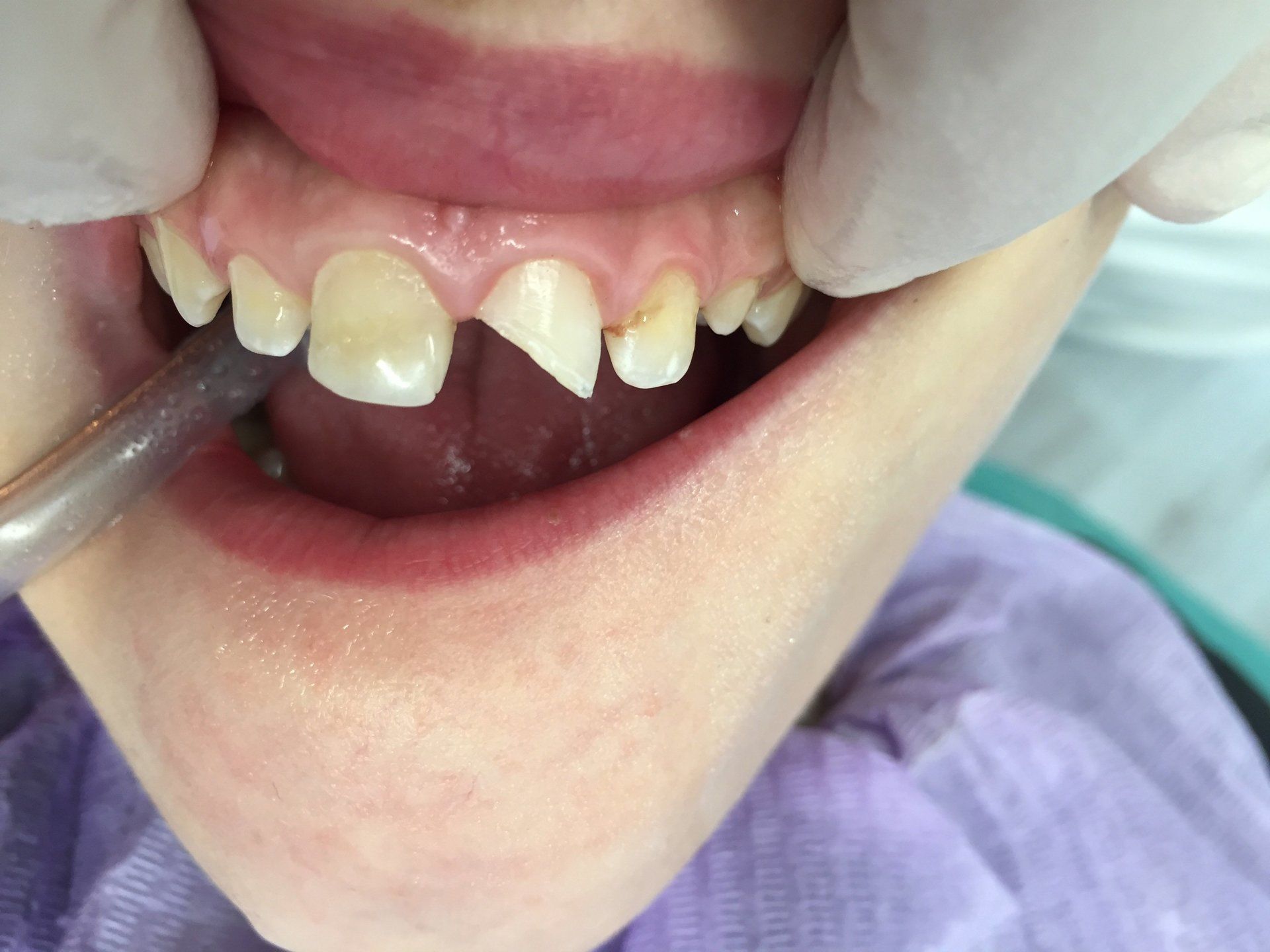 prima della ricostruzione