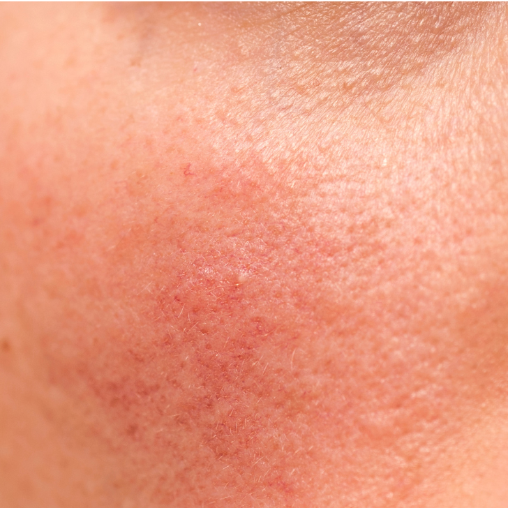 Treat rosacea with med spa treatments in Metairie | Chronos BHW