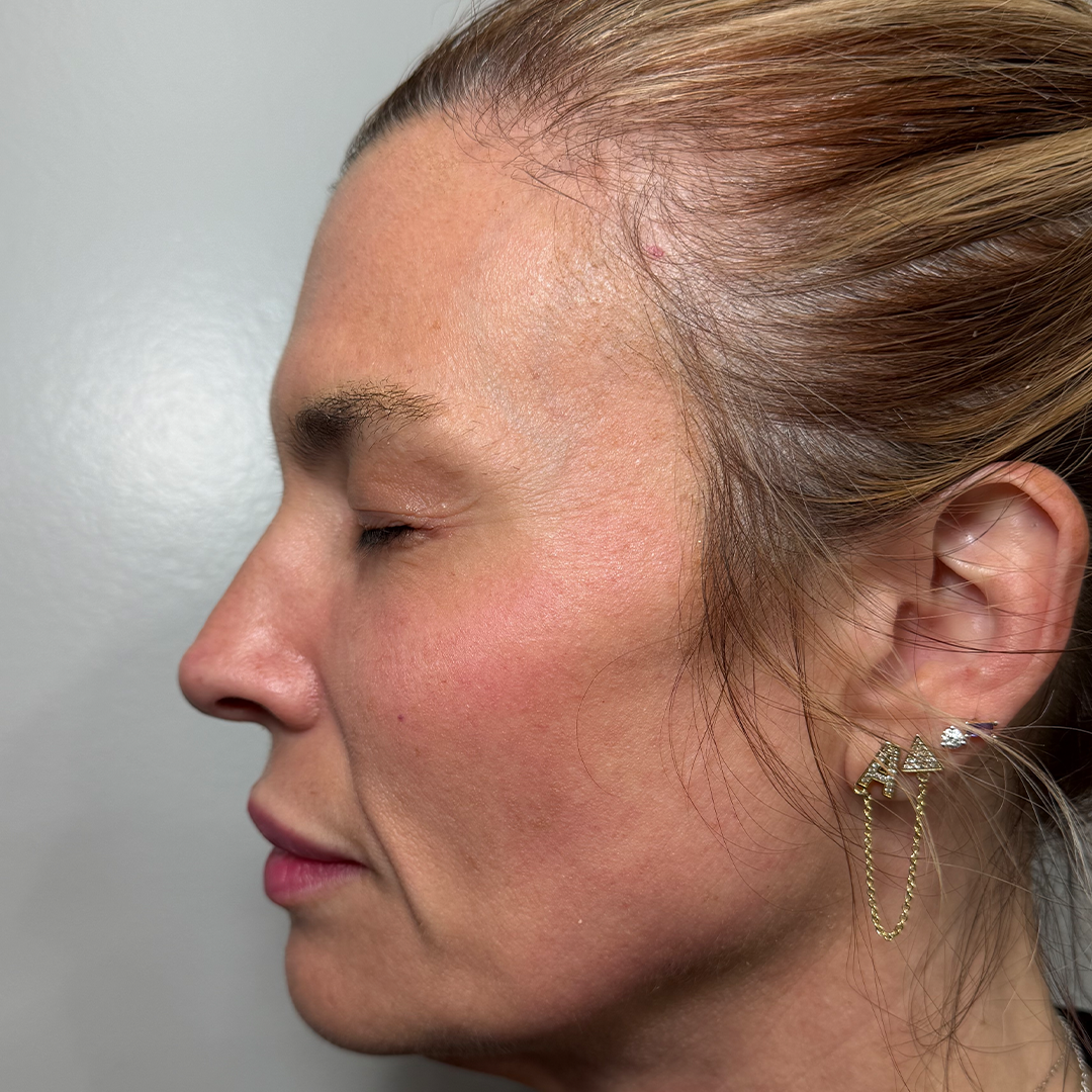 Moxi & BBL HEROic stacked laser treatment results in Metairie, LA | Chronos BHW