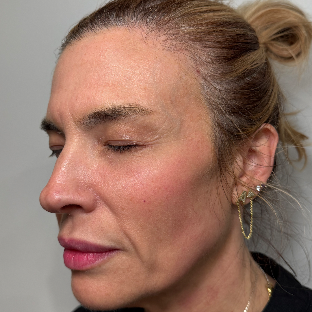 Moxi & BBL Laser treatment transformation in Metairie | Chronos BHW