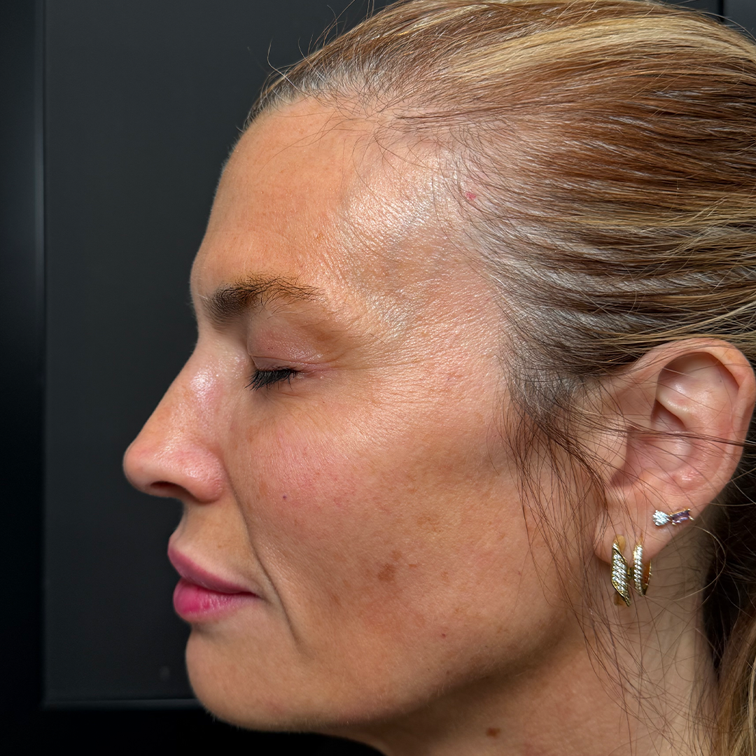 Moxi & BBL Treatments laser resurfacing in Metairie | Chronos BHW | Sciton Laser